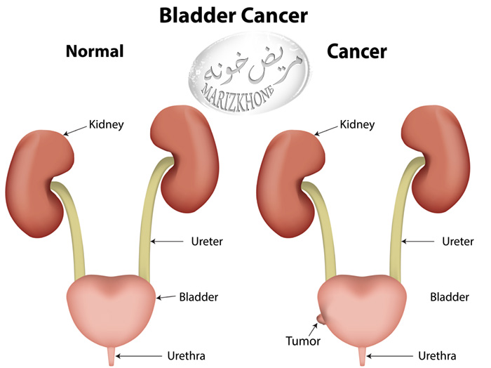 سرطان مثانه-Bladder Cancer