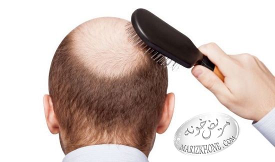 کاهش ریزش مو