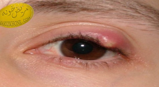 گل مژه چیست و چگونه درمان میشود-دکتر کی‌پور اپتومتریست و متخصص چشم پزشکی-پیشگیری از گل‌ مژه-درمان مبتلایان به گل مژه-راه درمان گل مژه
