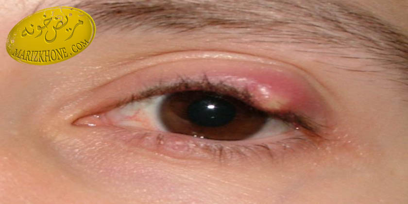 گل مژه چیست و چگونه درمان میشود-دکتر کی‌پور اپتومتریست و متخصص چشم پزشکی-پیشگیری از گل‌ مژه-درمان مبتلایان به گل مژه-راه درمان گل مژه