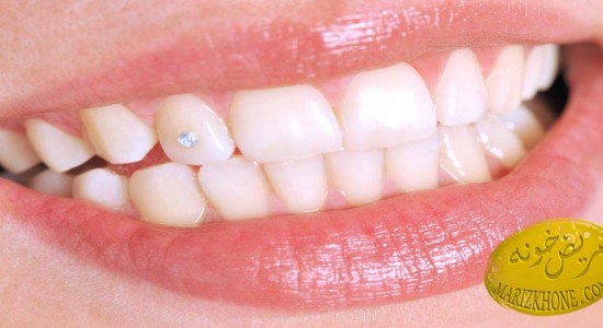 خطرات کاشت نگین روی دندان- پوسیدگی دندان-نگین دندان-کیوان ساعتی-عضو هیئت مدیره انجمن متخصصین ترمیم و زیبایی دندان-قدرت ضد باکتریال بزاق‌