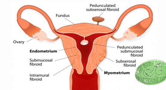روش انجام کولدوسنتز ,Retroverted uterus, فورسپس تناکولوم,کلامپ آلیس,نحوه معاینه دقیق لگنی,اسپکولوم داخل واژن