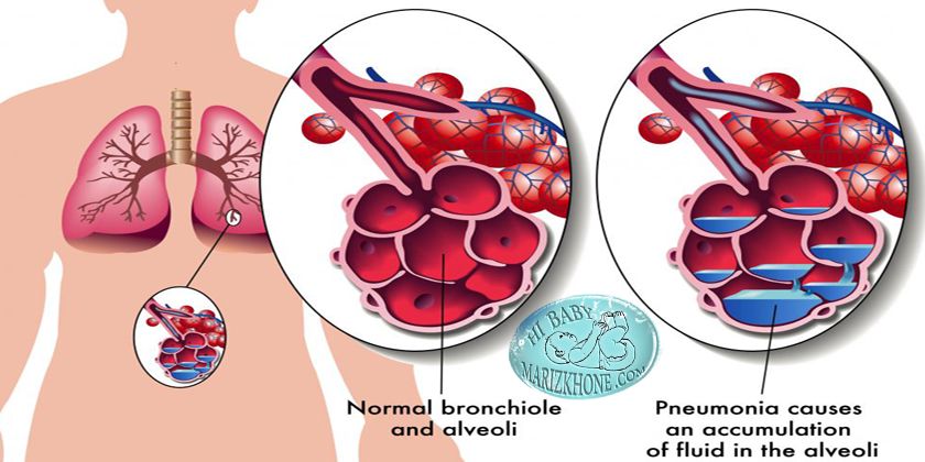 پنومونی باکتریال یا Bacterial pneumoni ,علت ابتلا به پنومونی باکتریال,علائم ابتلا به پنومونی باکتریال,درمان بیماری پنومونی باکتریال