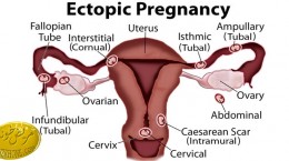 علت ابتلای افراد به حاملگی نابجا ,حاملگی خارج رحمی,روشهای جلوگیری از حاملگی,نحوه انتقال تخم لقاح یافته به داخل رحم,اختلال آناتومیک,قرص های ضد بارداری