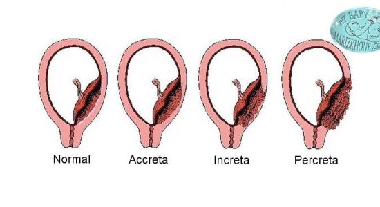 باقی ماندن تکه هایی از جفت در رحم -سندرم آشرمن-حاملگی های متعدد-کوتیلدون-کوتیلدونهای جفت-کورتاژ-Retained Placental Fragments-چسبندگی غیر طبیعی جفت