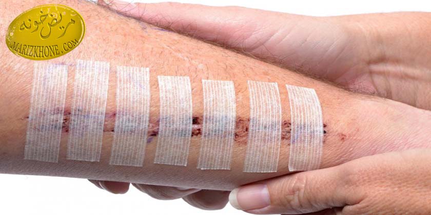 هشدار های مراقبتی از انواع زخم های بدن -چه مدت طول میکشد زخم روی بدن بهبود یابد-مراقبت از زخم های روی صورت-مراقبت از زخم ناشی از سوختگی-زخم های روی بدن