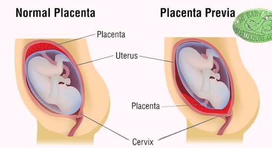 جفت سرراهی یا Phacenta previa -علت خونریزی فعال در سه ماهه سوم بارداری-شایع ترین علامت جفت سرراهی-خونریزی واژینال-معاینه رحم-آتروفی