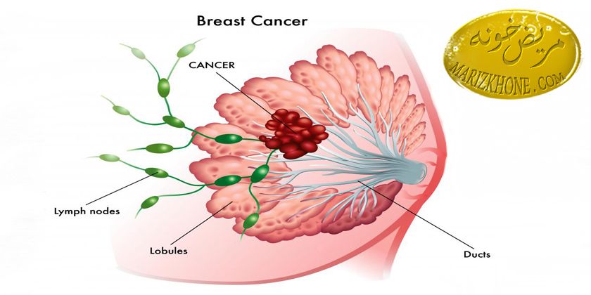 افزایش ابتلا به سرطان سینه با مصرف استروژن در یائسگی ,علائم ابتلا به یائسگی,رفع عوارض یائسگی در زنان,مضرات افزایش هورمون استروژن درزنان,پیشگیری ازسرطان سینه