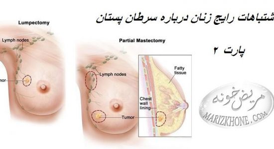 توده سرطان پستان