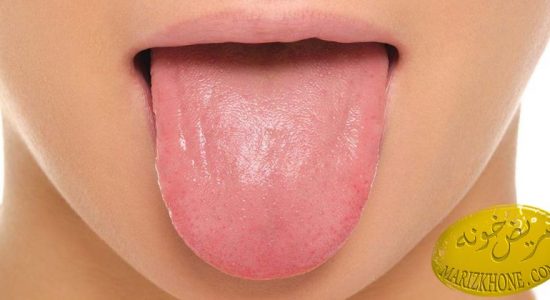 تشخیص بیماری از روی شکل زبان ,زبان افراد مبتلابه بیماری دیابت,علت جوش یازخم روی زبان,علائم ابتلا به عفونت قارچی زبان,علت ایجادخطوط سفید برروی زبان,زبان سیاه