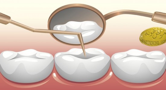 حفره دندان خود را در کمتر از 20دقیقه پر کنید ,علائم پوسیدگی دندان ها,علت پوسیدگی دندان,چسبی جدید برای پر کردن دندان,پر کردن دندان در خانه,نحوه پر کردن دندان