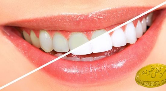 سفید کردن دندانها