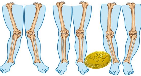 تشخیص پای پرانتزی در کودکان
