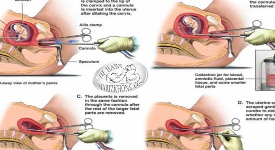 سقط جنین در ماههای اول بارداری