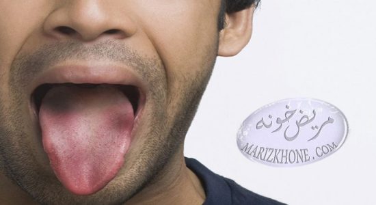 درمان سریع سوختگی زبان