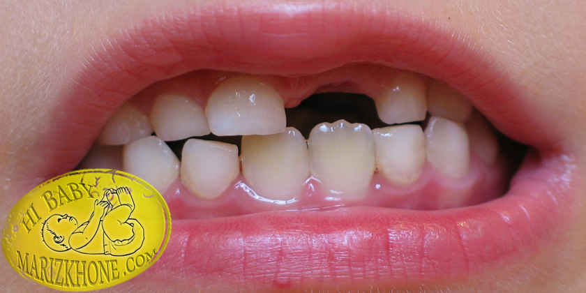 کشیدن دندان‌های شیری کودکان چه عوارضی دارد
