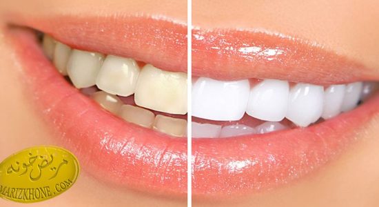 روشهای سفید کردن دندان ها