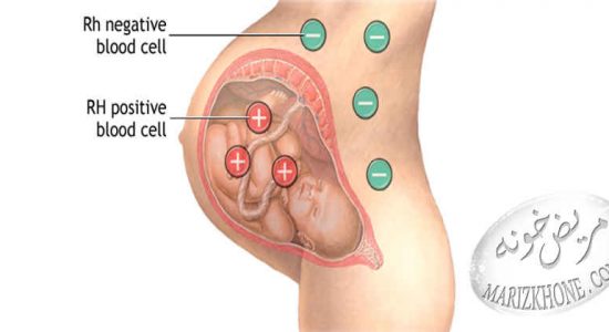 عامل ارهاش (RH) و ناسازگاری خونی مادر و جنین