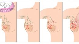 پیشگیری از سرطان پستان با خوردن سرشیر
