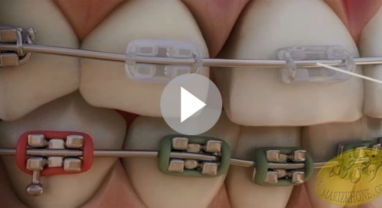 انیمیشن ارتودنسی دندان