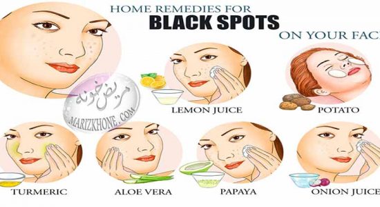 درمان لکه های سیاه روی پوست صورت