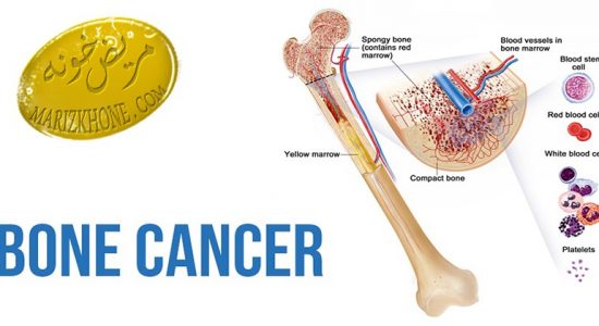 درمان سرطان استخوان