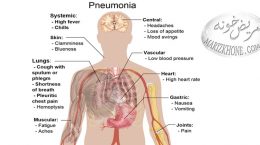درمان پنومونی