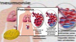 بیماری پنومونی