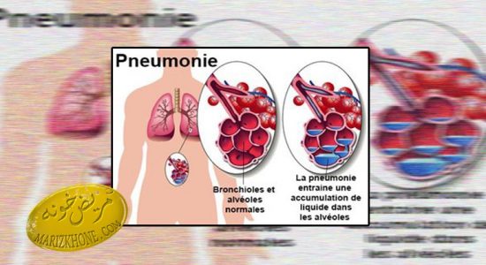 بیماری پنومونی